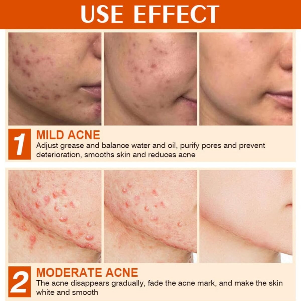 Acne Cream Pimple Cream for Face, Oil Control Pimple Remover Cream Get Rid of Pimples Fast,for Oily and Acne Prone Skin, Cruelty Free, Crema para espinillas en la cara - Image 4