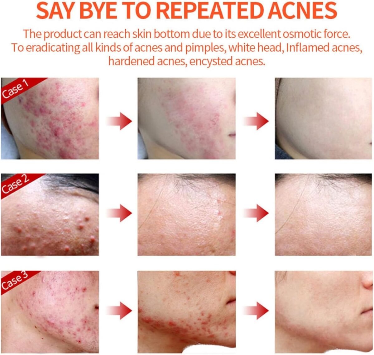 Acne Cream Pimple Cream for Face, Oil Control Pimple Remover Cream Get Rid of Pimples Fast,for Oily and Acne Prone Skin, Cruelty Free, Crema para espinillas en la cara - Image 7